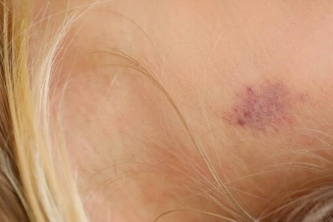 how to.get rid of dark hickeys on.neck