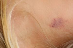 Tips on How To Get Rid Of Hickeys